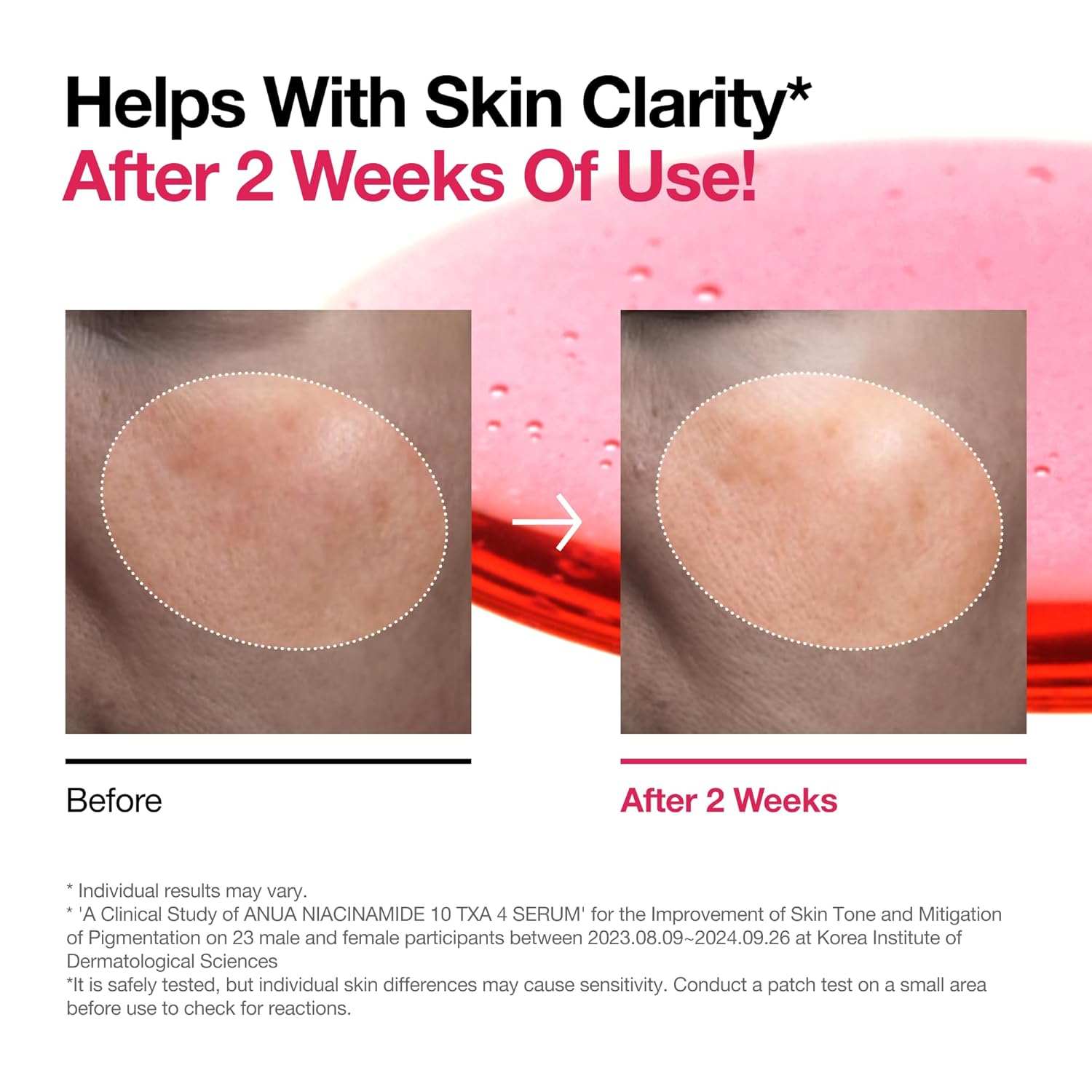 ANUA Niacinamide 10 + TXA 4 Serum, Hyaluronic Acid, Tranexamic acid, Facial Serum For GlassSkin, Glow Back Serum, Dark Spot Care, Postnatal Skincare, Korean Skincare (30ml/1.01 fl.oz)